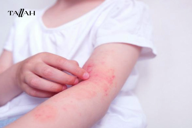 علاج حساسية المانجو في المنزل