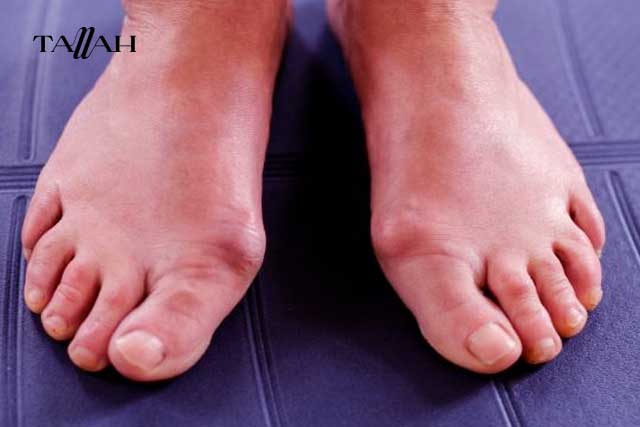 تورم اصابع القدم في الشتاء