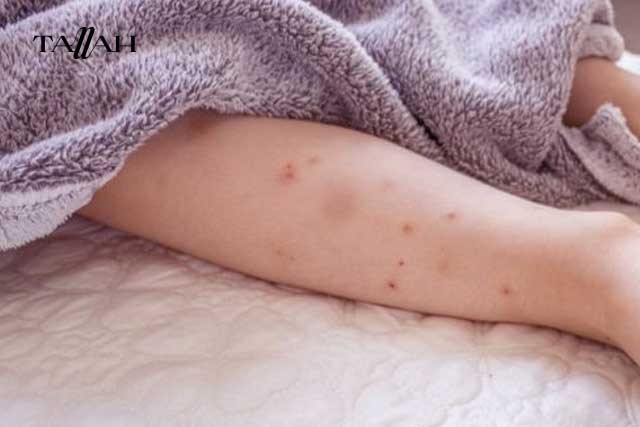 كيفية التخلص من البراغيث في الفراش