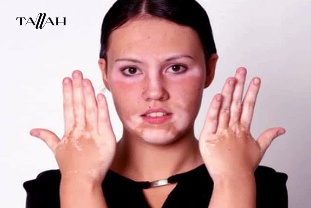 مرض البهاق عند النساء