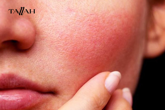 البشرة الحساسة