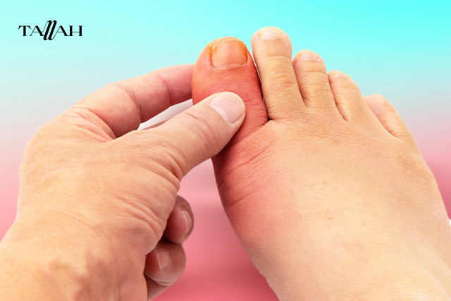 ماهو مرض النقرس وماهو علاجه