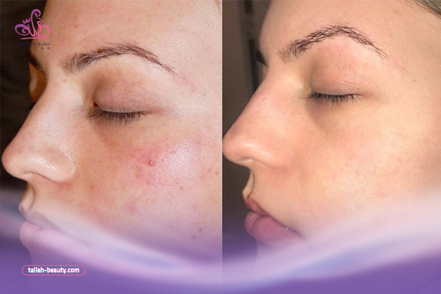 أفضل 6 زيوت للبشرة الحساسة والمعرضة للالتهاب