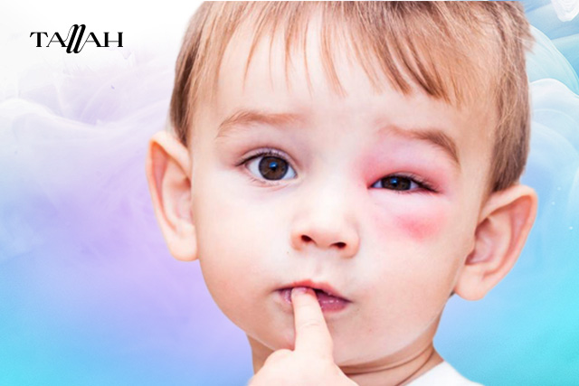 اعراض التهاب العين عند الاطفال