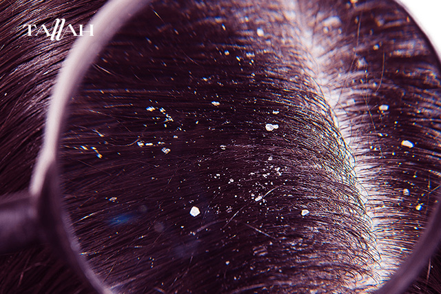 انواع قشرة الشعر