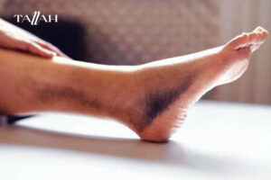 شكل جلطة الساق