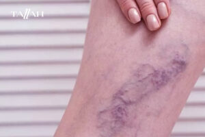 علامات الشفاء من جلطة الساق