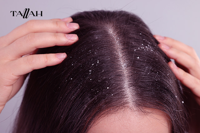 شامبوهات للقشرة الدهنية