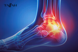 علاج الشوكة العظمية نهائيا