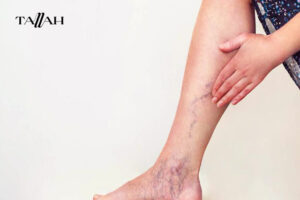 مدة الشفاء من جلطة الساق