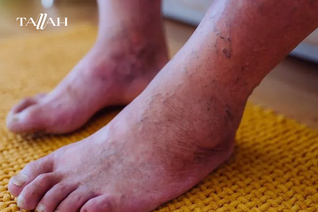 اعراض جلطة الساق