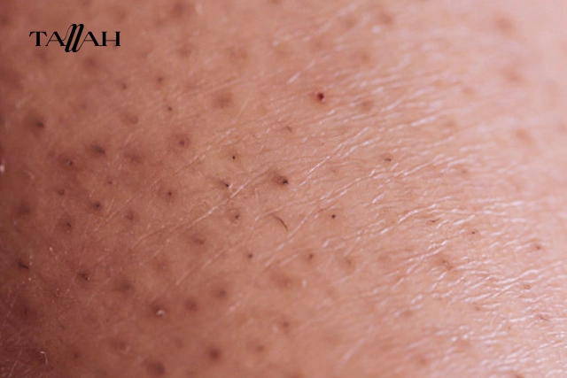 هل إزالة الشعر بالحلاوة يسبب جلد الوزة؟