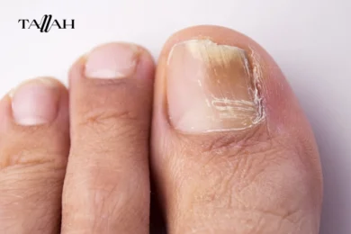 علاج انواع فطريات الاظافر