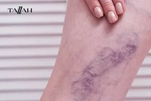 أعراض جلطة الرجل اليمنى