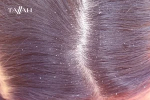 أسباب قشرة الشعر عند الأطفال