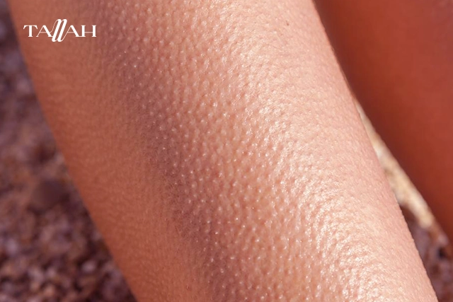 تجربتي في علاج جلد الوزة بالليزر