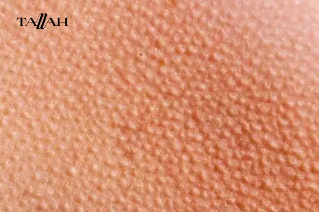 هل إزالة الشعر بالشفرة تسبب جلد الوزة؟