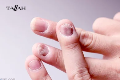 مرهم لعلاج علاج فطريات الاظافر