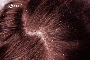 ما هو علاج قشرة الرأس عند الأطفال؟