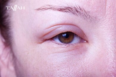 التخلص من انتفاخ العين بعد البكاء