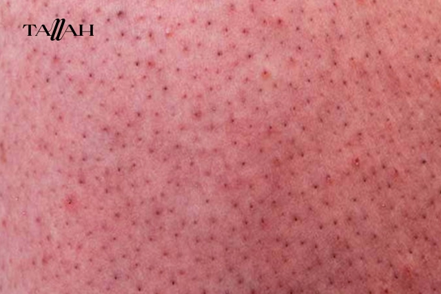 كيف أزيل الشعر الذي تحت الجلد؟