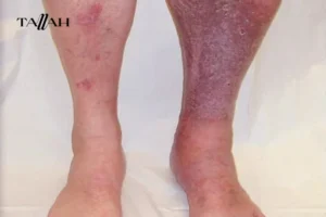 شكل جلطة الرجل