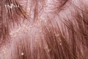 شامبو لعلاج قشرة الشعر عند الأطفال