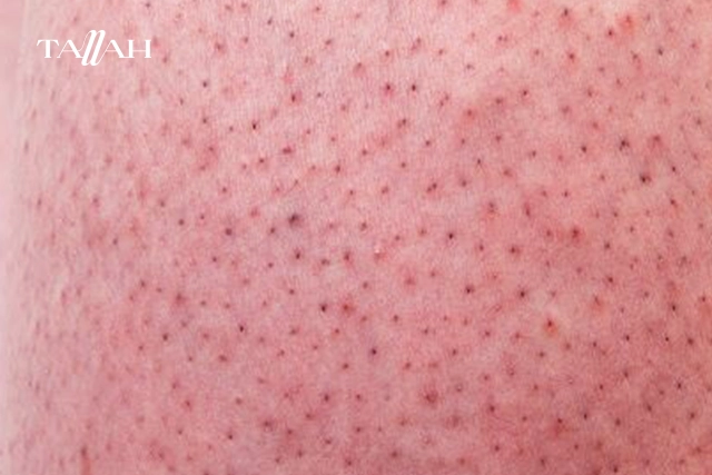 هل الفازلين حلو لجلد الوزه؟