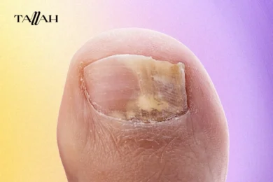 علاج فطريات الاظافر