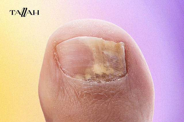 علاج فطريات الاظافر