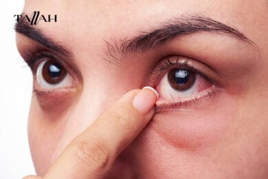 طرق علاج انتفاخ تحت العين 