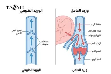 اعراض دوالي الساقين للحامل
