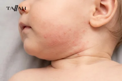 شكل حساسية الالبان عند الرضع 